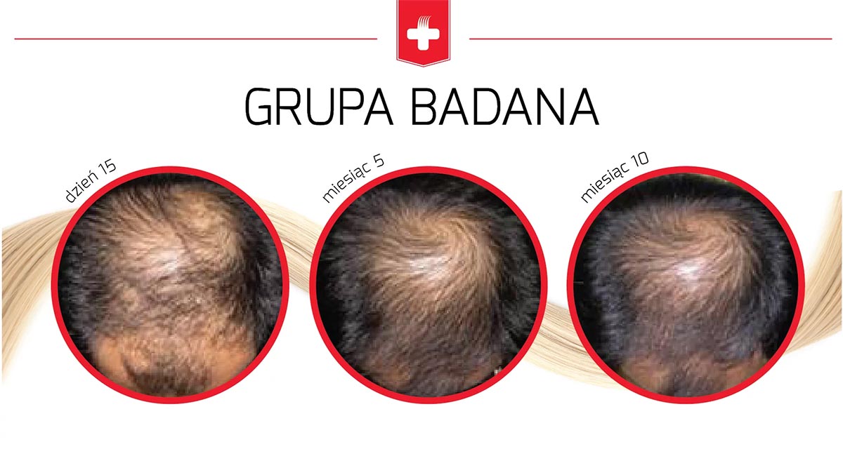 Dobry preparat na łysienie i wypadanie włosów u mężczyzn – czy taki istnieje?